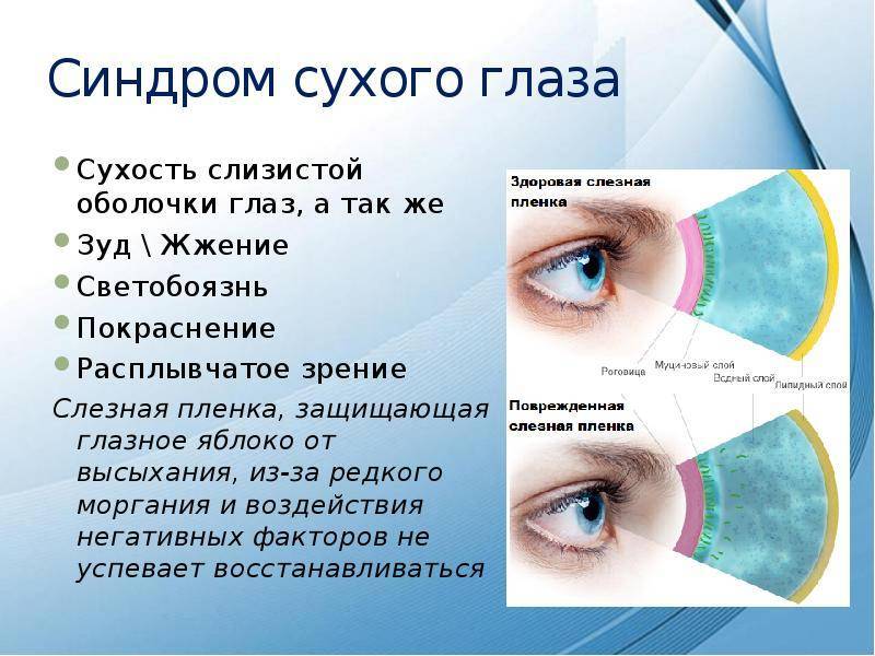 На на на постой на глаза. Синдром сухого глаза причины. Синдром сухого глаза покраснение. Синдром сухого глаза покраснение глаз.