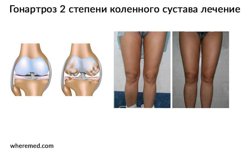 Гонартроз коленного сустава лечение препараты